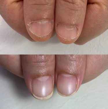 03-1　　ささくれ・皮膚あれ　育成前・結果